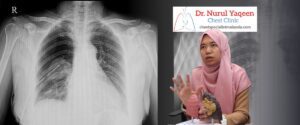 Pneumothorax