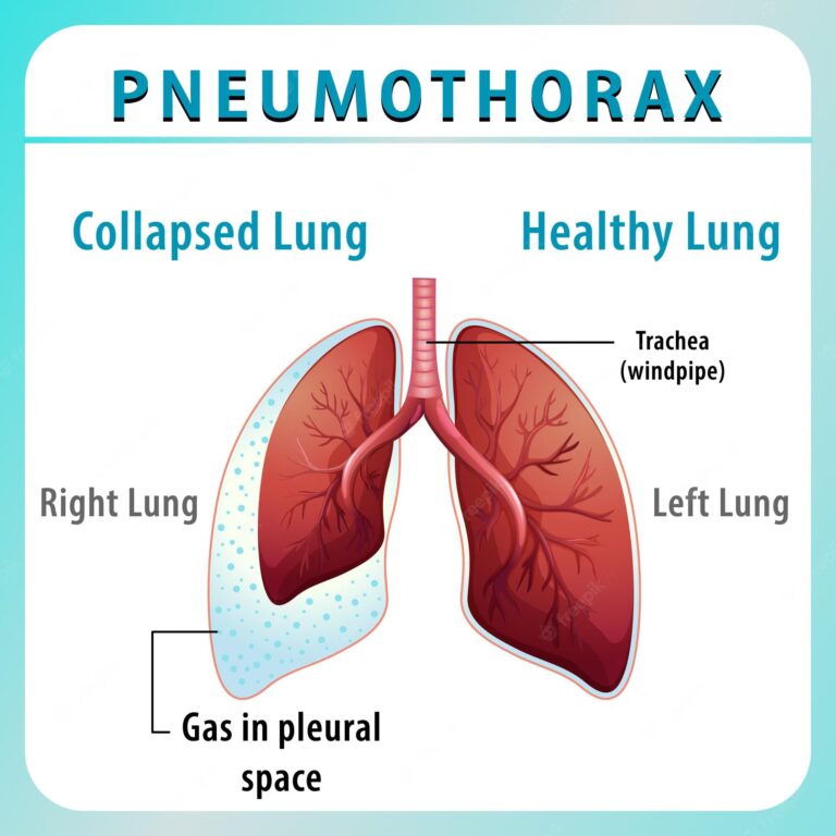 Pneumothorax: Symptoms, Causes, And Treatment For Malaysians